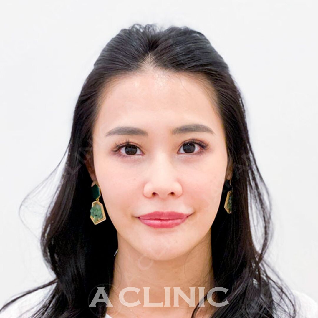 Aスレッドでアプリ加工いらずの小顔を手に入れませんか！処置前と処置直後の症例です(30代女性) BEFORE