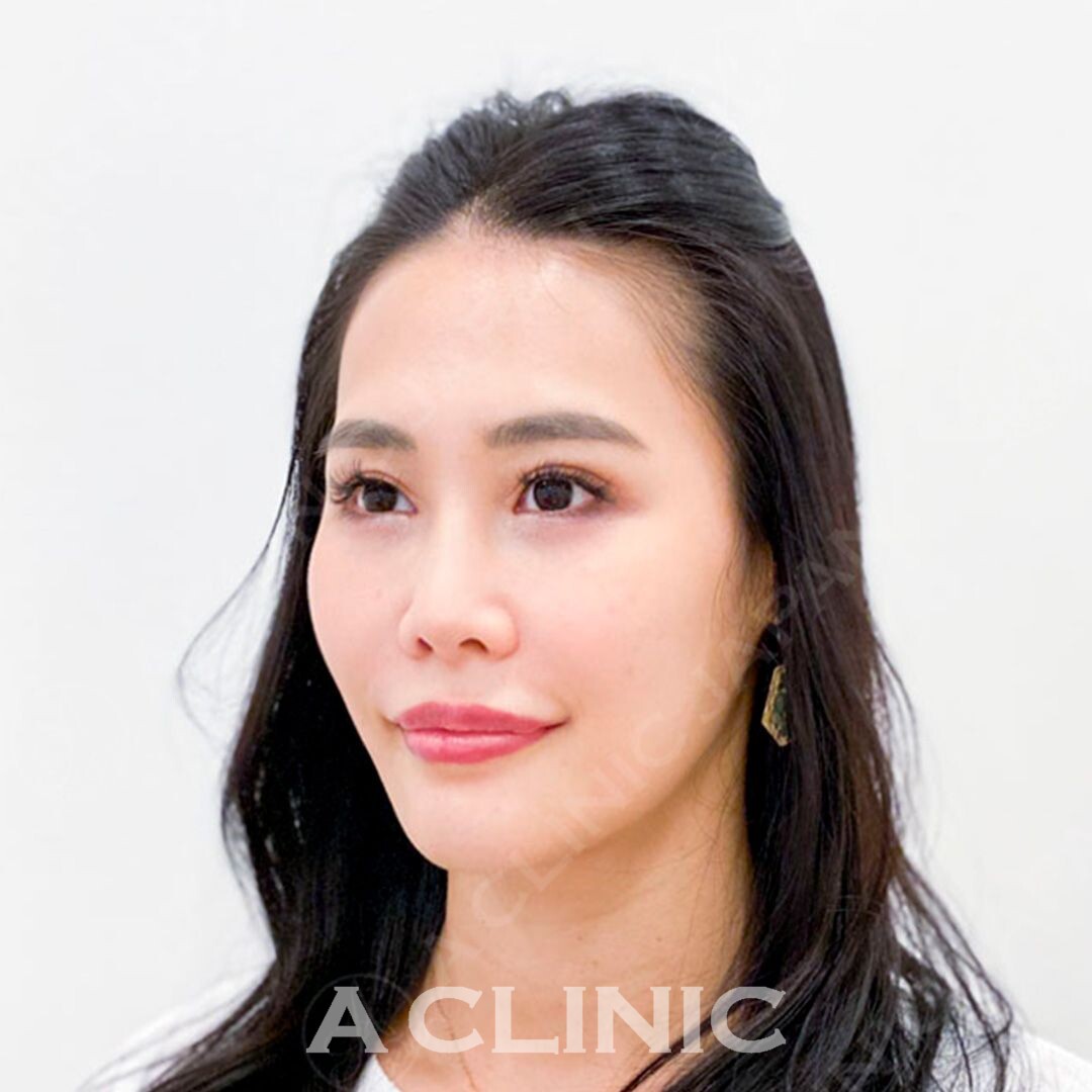 Aスレッドで気になるたるみやもたつきを瞬時に解決してくれます！処置前と処置直後の症例です(30代女性) BEFORE