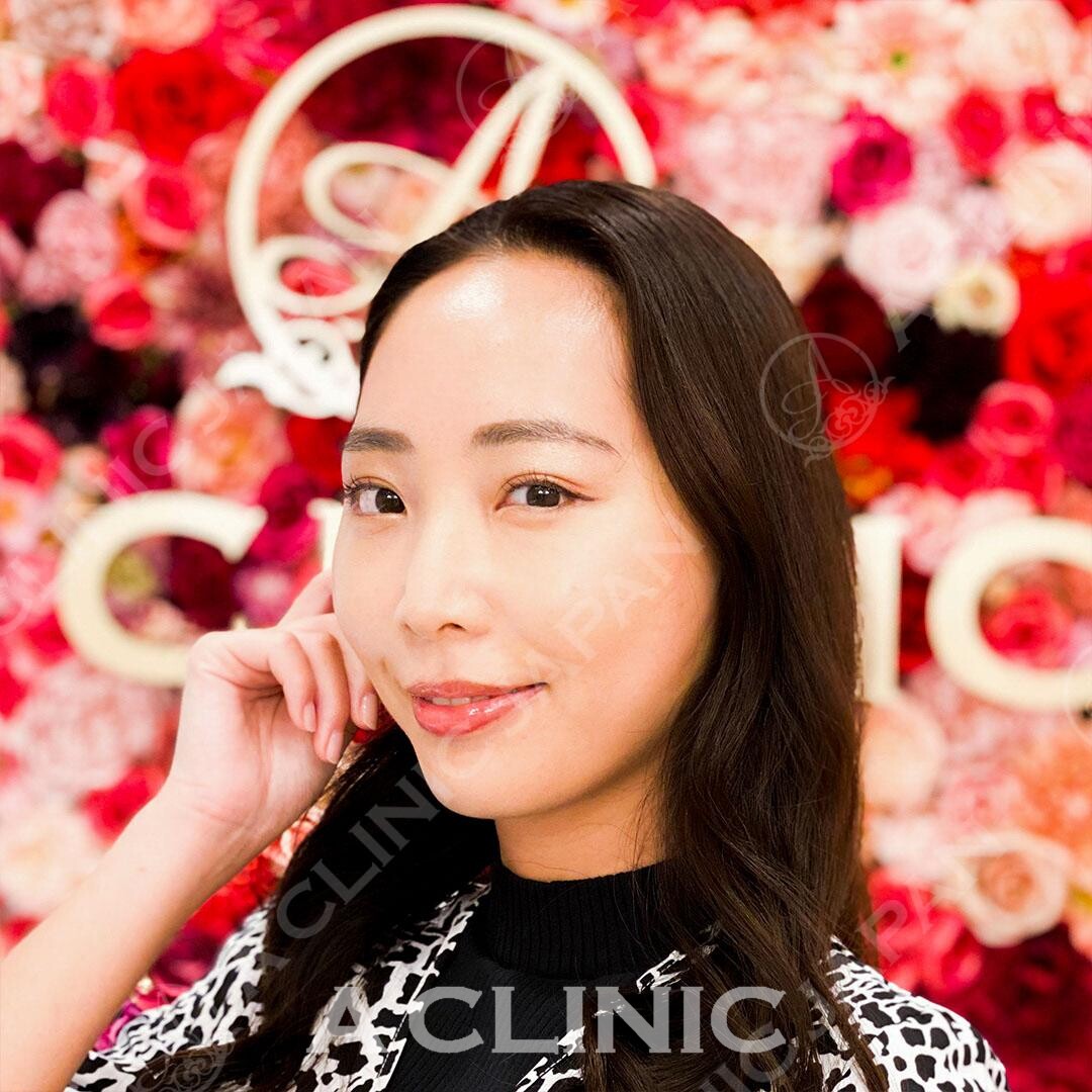 たった15分で綺麗なフェイスラインに！Aスレッドの処置前と処置直後の症例です(30代女性) AFTER