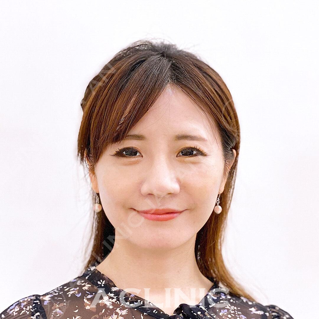 Aスレッドは少ない本数でもしっかりと引き上がるので効果抜群です！処置前と処置直後の症例です(30代女性) AFTER