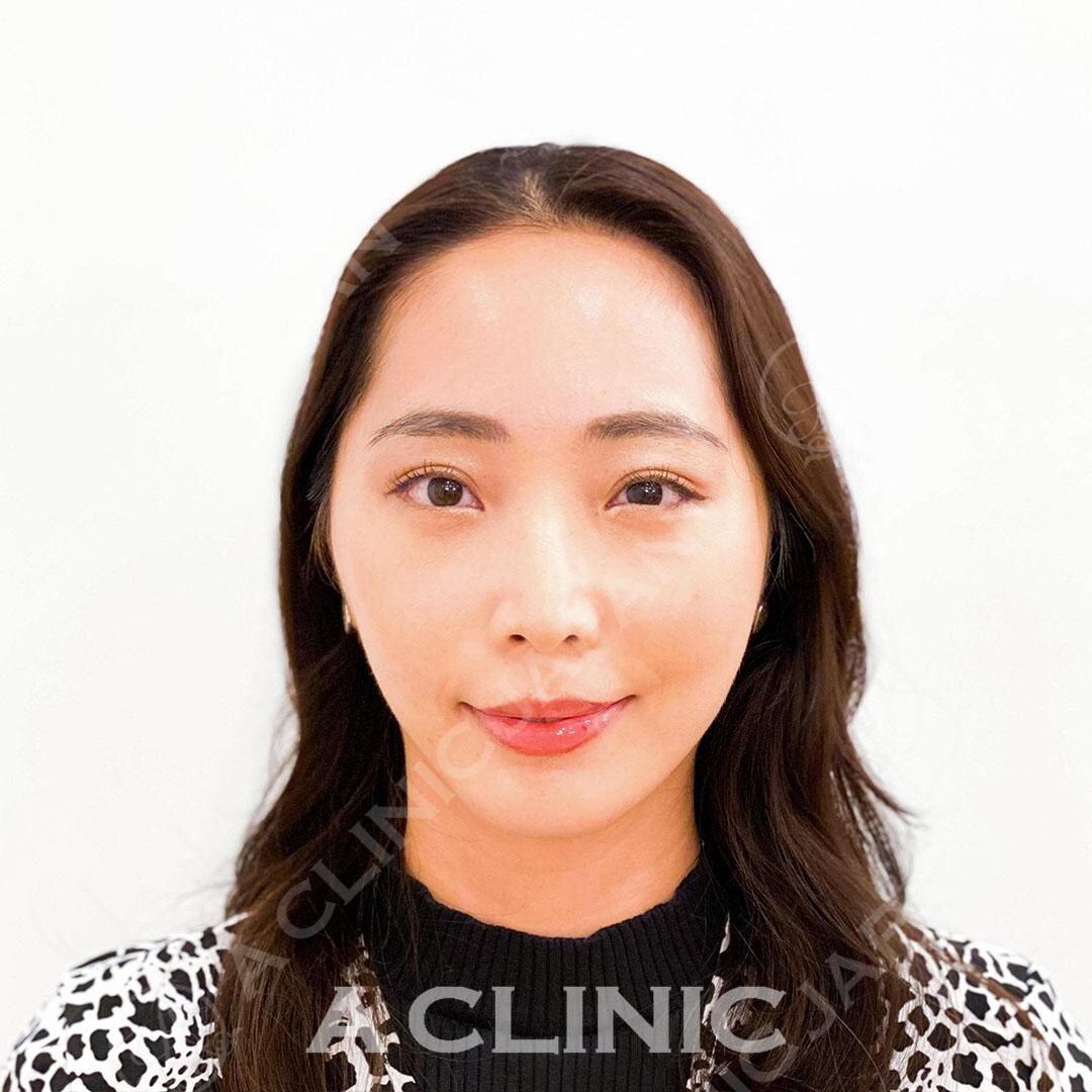 Aスレッドでお顔のもたつきを一気に解消！処置前と処置直後の症例です(30代女性) AFTER