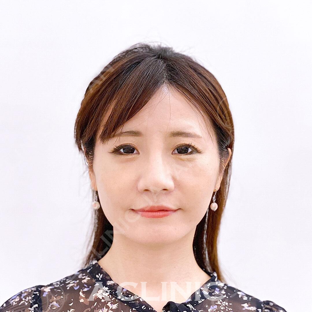 Aスレッドは少ない本数でもしっかりと引き上がるので効果抜群です！処置前と処置直後の症例です(30代女性) BEFORE