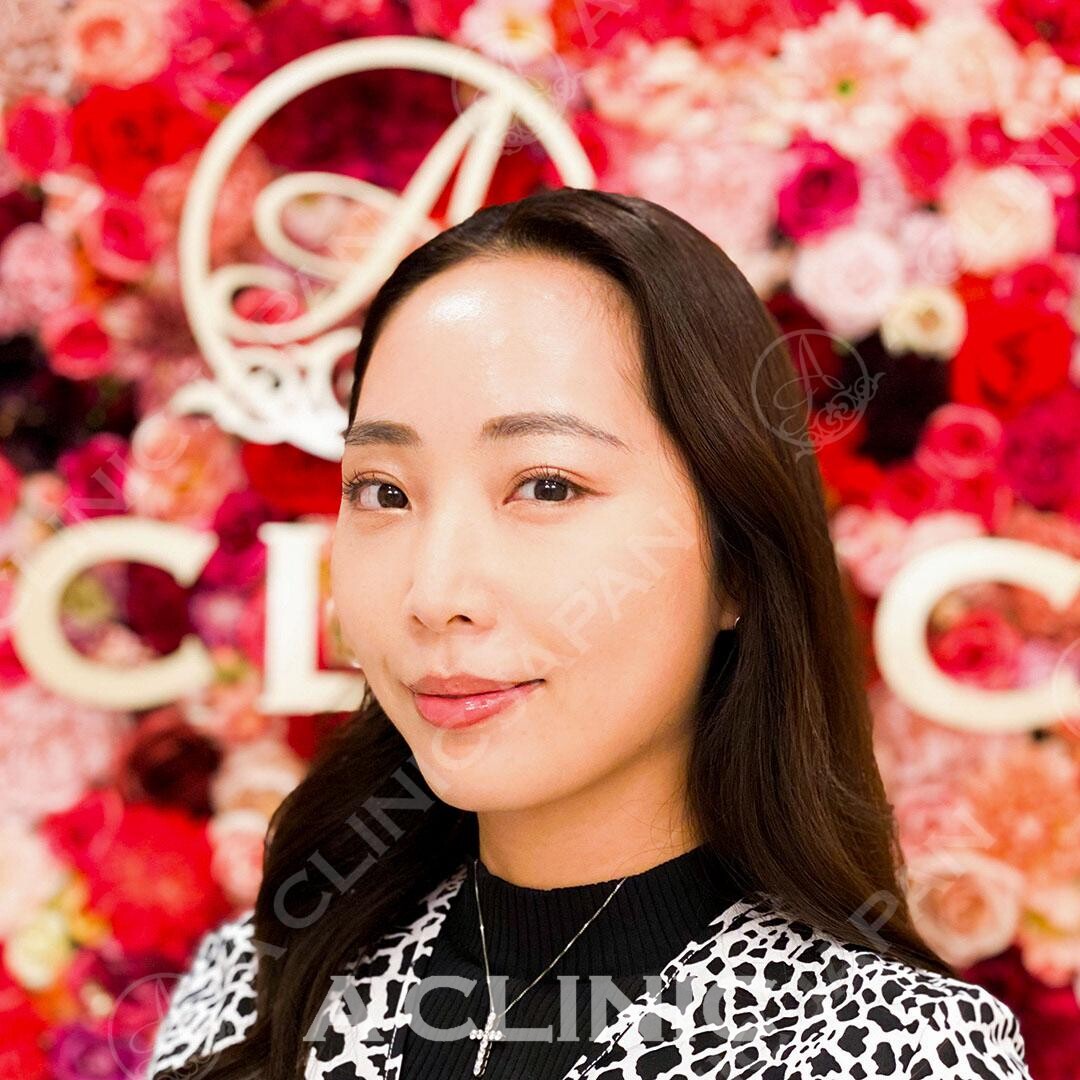 たった15分で綺麗なフェイスラインに！Aスレッドの処置前と処置直後の症例です(30代女性) BEFORE