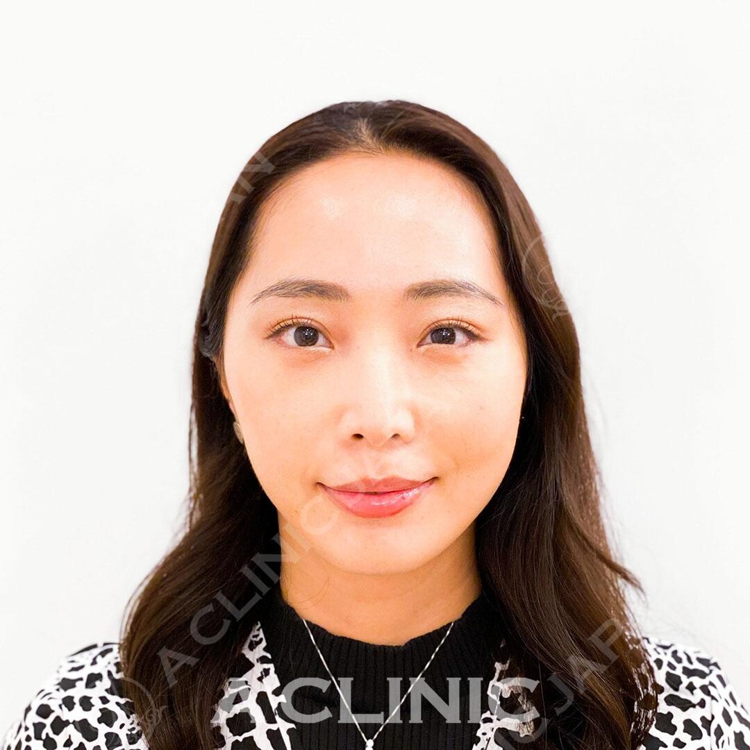 Aスレッドでお顔のもたつきを一気に解消！処置前と処置直後の症例です(30代女性) BEFORE