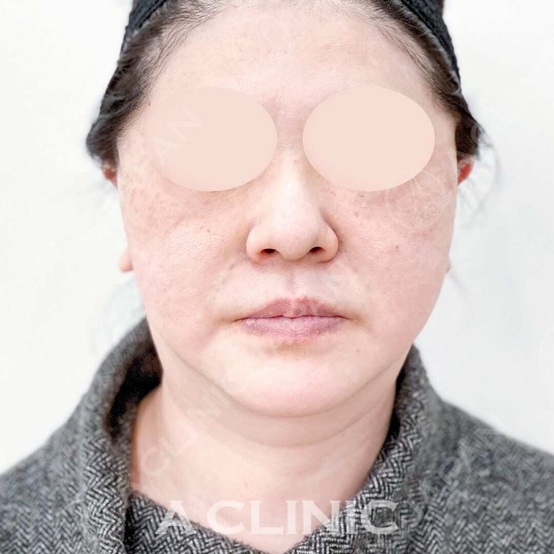 オーダーメイドで気になる部分をしっかり引き上げ！Aスレッドの処置前と処置直後の症例です(50代女性) AFTER