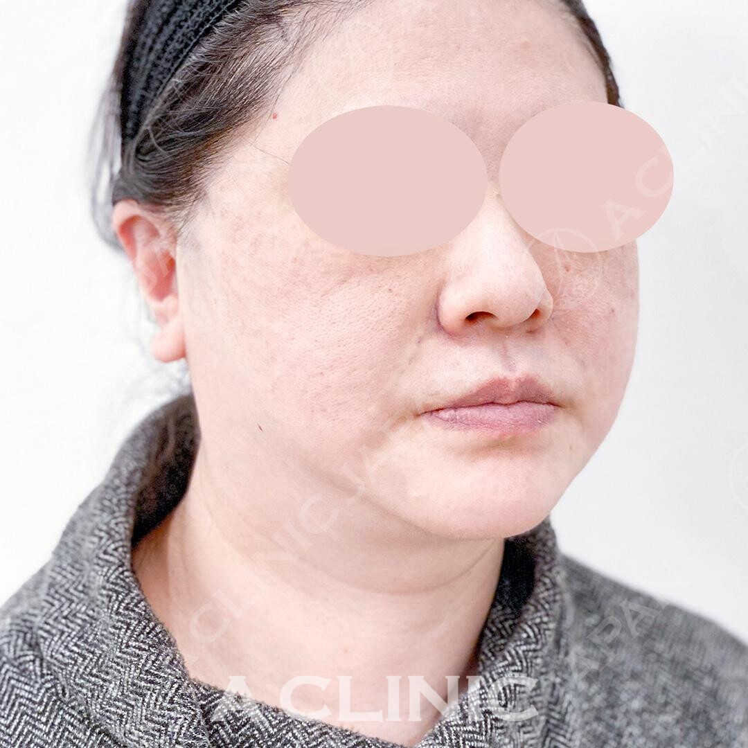 たるみの引き上げだけでなく美肌効果も！Aスレッドの処置前と処置直後の症例です(50代女性) AFTER