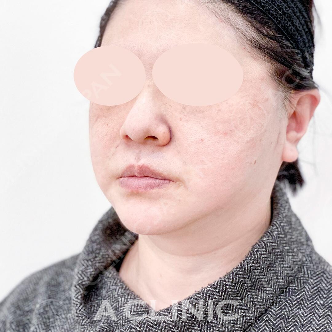 フェイスラインのたるみがご覧の通りしっかり引きあがりました！Aスレッドの処置前と処置直後の症例です(50代女性) AFTER