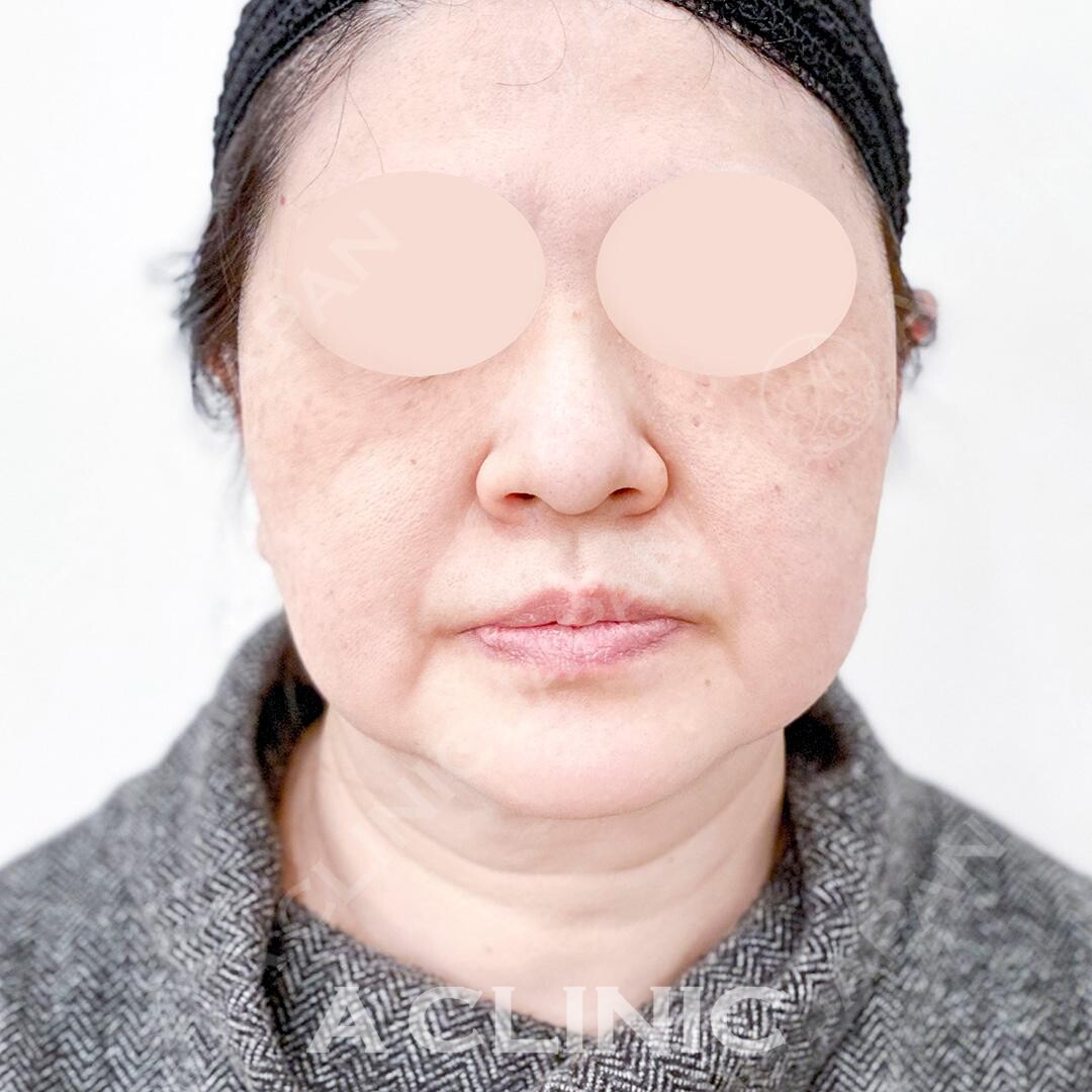 オーダーメイドで気になる部分をしっかり引き上げ！Aスレッドの処置前と処置直後の症例です(50代女性) BEFORE