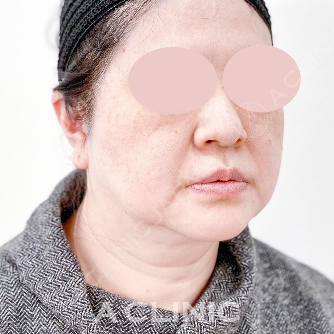 たるみの引き上げだけでなく美肌効果も！Aスレッドの処置前と処置直後の症例です(50代女性) BEFORE