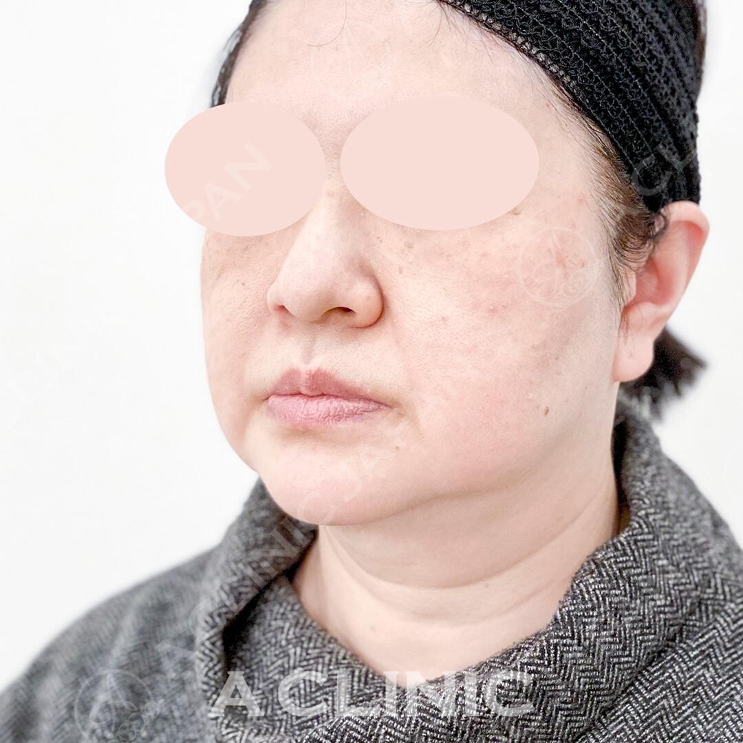 フェイスラインのたるみがご覧の通りしっかり引きあがりました！Aスレッドの処置前と処置直後の症例です(50代女性) BEFORE