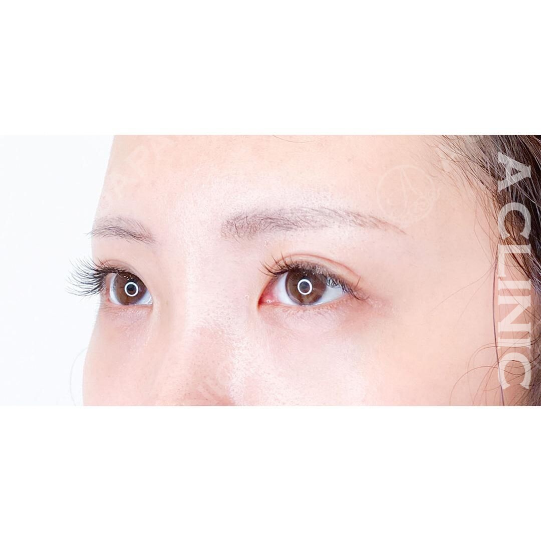 女性らしく優しい印象のお目元に変身！パーフェクトアイズの処置前と2週間後の症例です(20代女性) AFTER