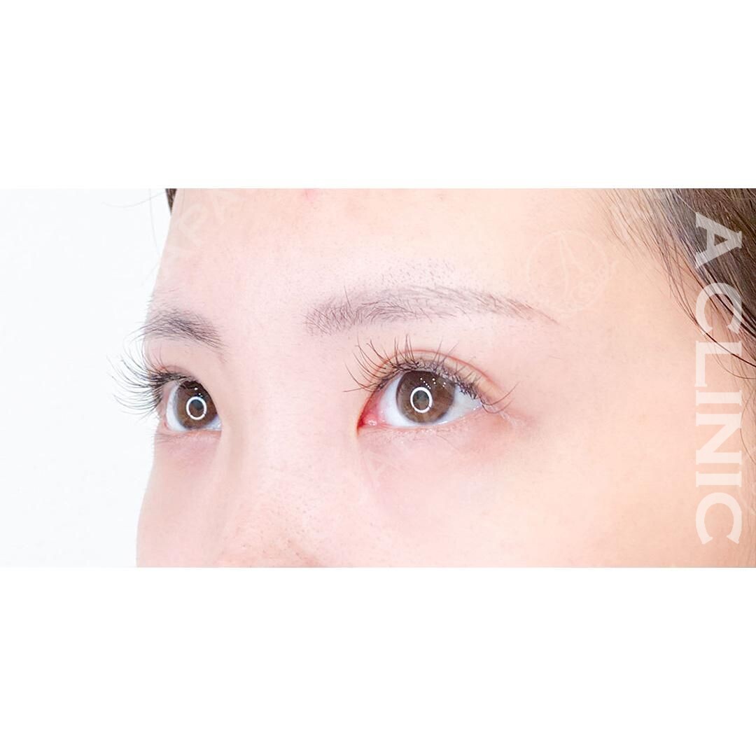 女性らしく優しい印象のお目元に変身！パーフェクトアイズの処置前と2週間後の症例です(20代女性) BEFORE