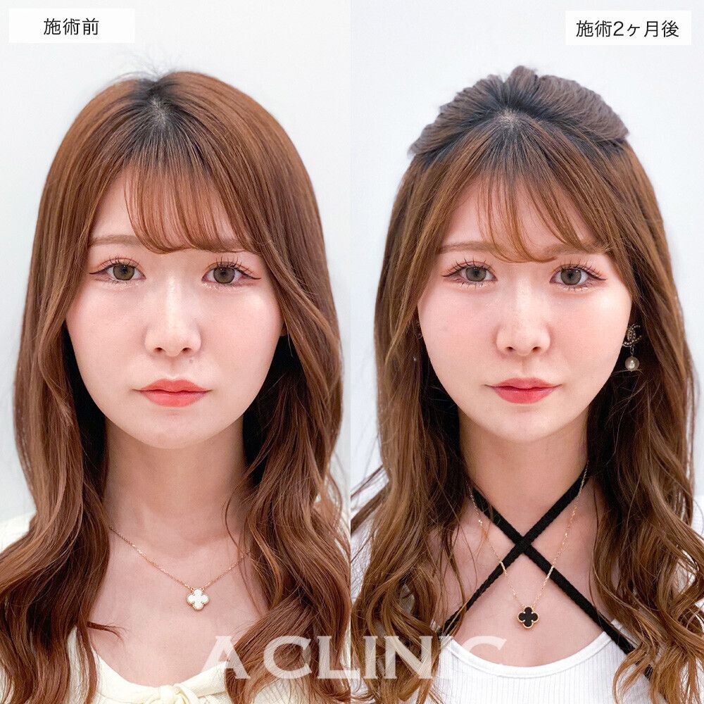 1回の施術でお顔の気になる脂肪をしっかり除去！こちら1day小顔脂肪吸引の処置前と処置直後の症例写真です(20代女性)