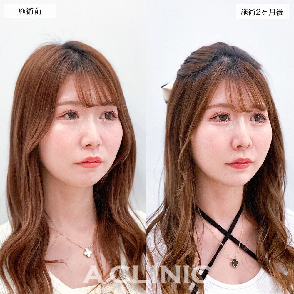 1回の施術でお顔の気になる脂肪をしっかり除去！こちら1day小顔脂肪吸引の処置前と処置直後の症例写真です(20代女性)