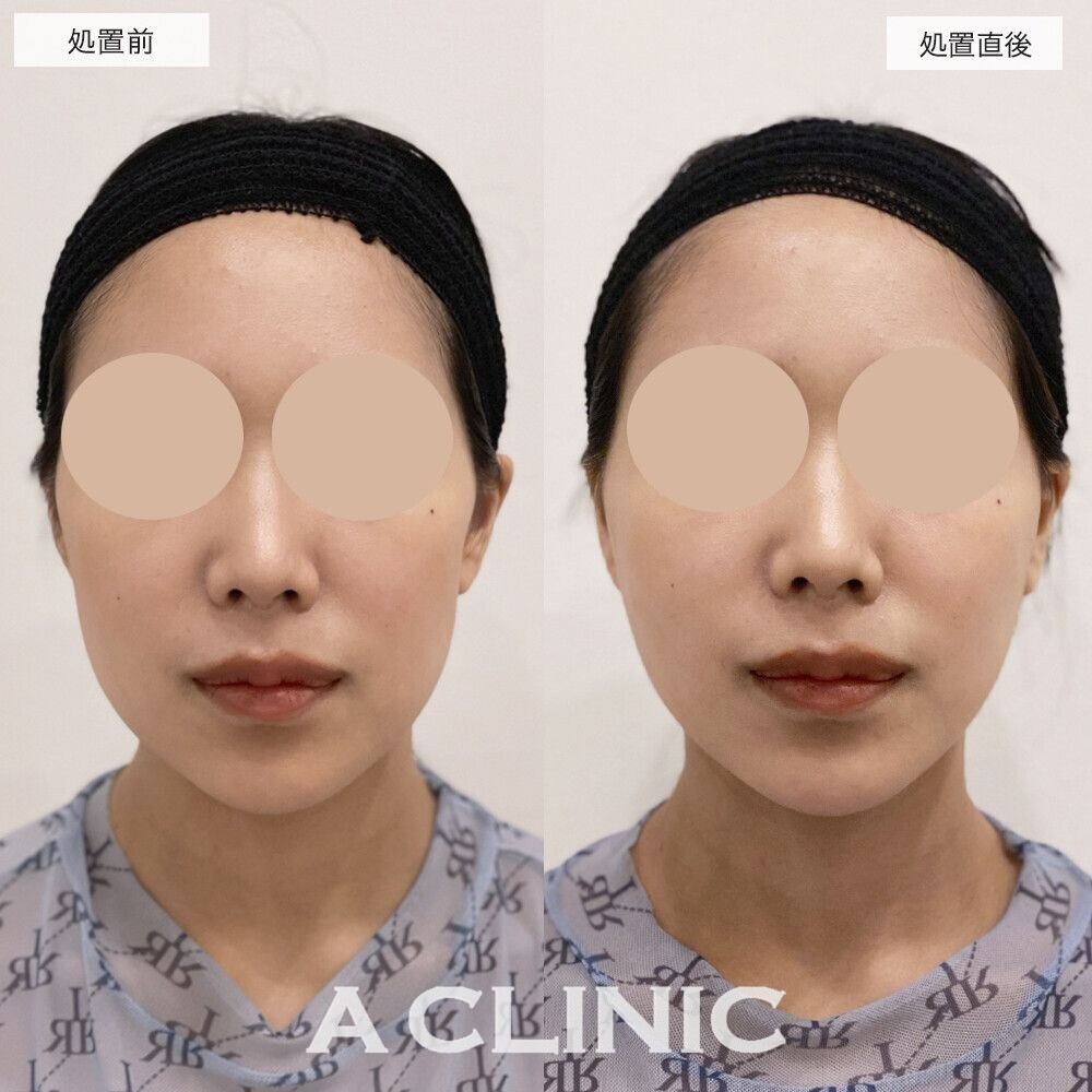 頬骨下へヒアルロン酸を注入することで手軽に輪郭のバランスが整います！エッグフェイスの処置前と処置直後の症例です(20代女性)