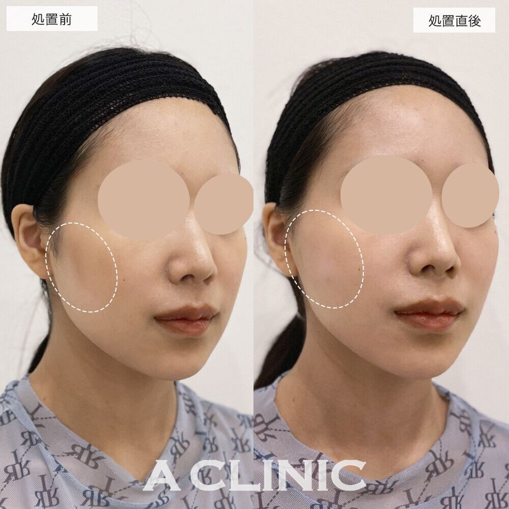 頬骨下へヒアルロン酸を注入することで手軽に輪郭のバランスが整います！エッグフェイスの処置前と処置直後の症例です(20代女性)