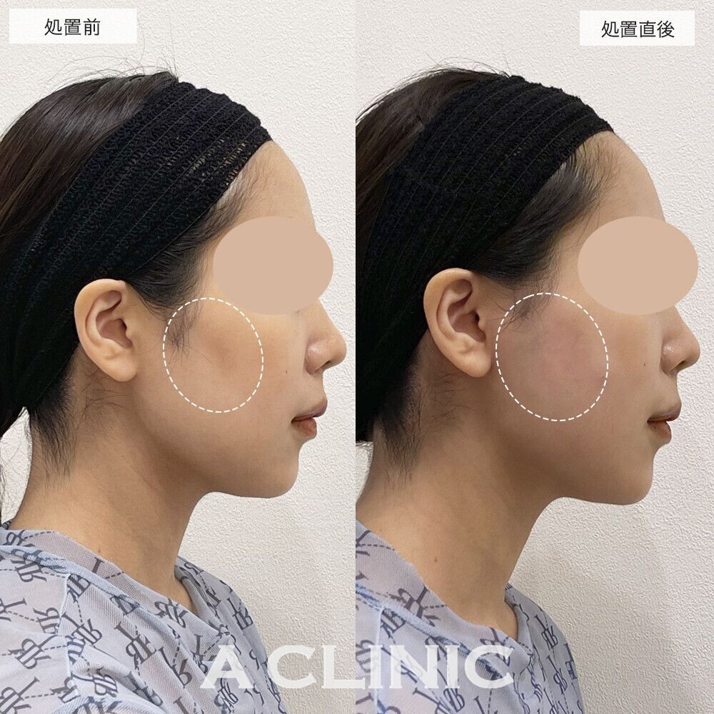 頬骨下へヒアルロン酸を注入することで手軽に輪郭のバランスが整います！エッグフェイスの処置前と処置直後の症例です(20代女性)