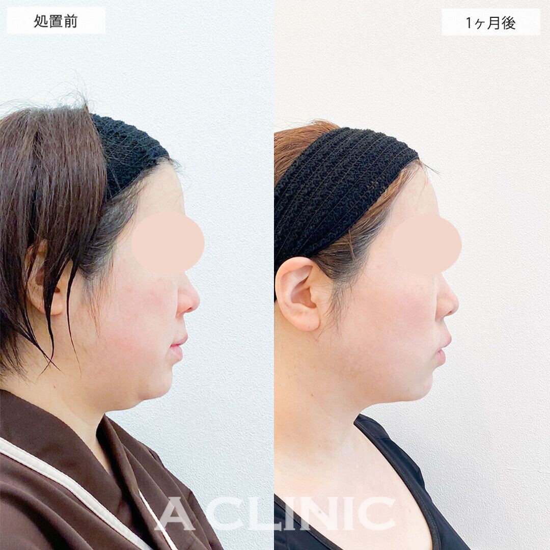 1day小顔脂肪吸引で輪郭回りがかなりスッキリしました！処置前と1ヶ月後の症例です(20代女性)