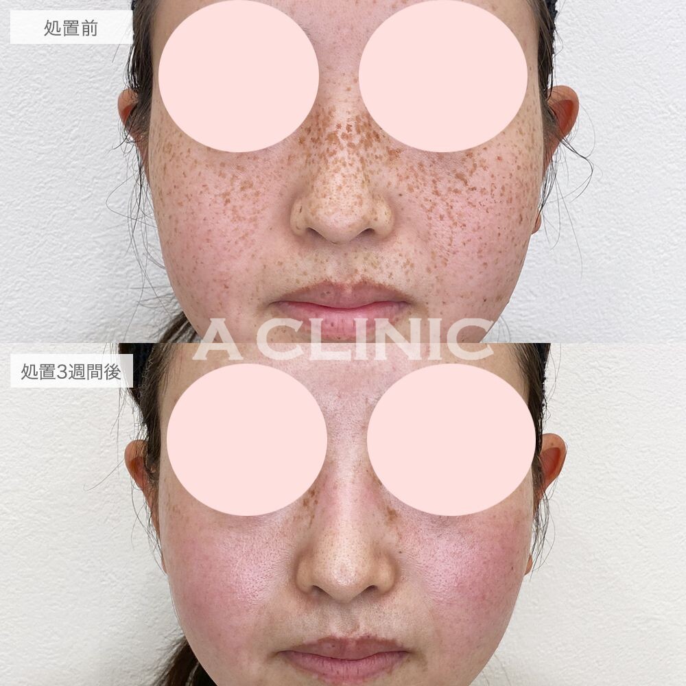 顔全体に広がっていたそばかすが改善しました！ピコスポットの処置前と3週間後の症例です(20代女性)