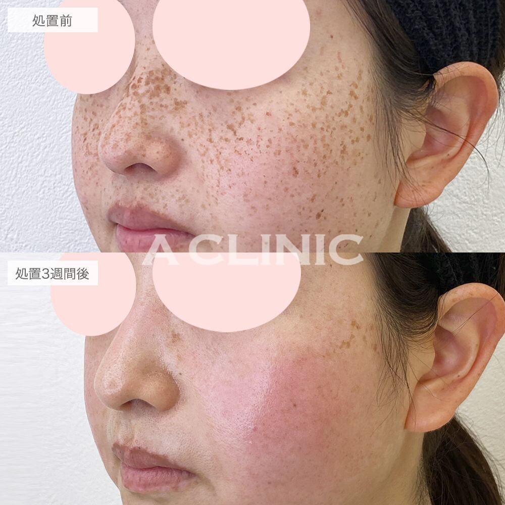 顔全体に広がっていたそばかすが改善しました！ピコスポットの処置前と3週間後の症例です(20代女性)