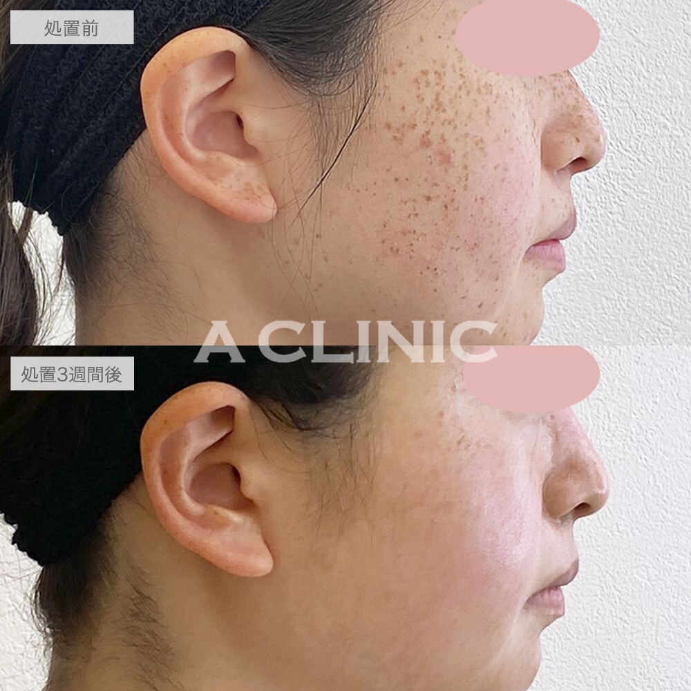 顔全体に広がっていたそばかすが改善しました！ピコスポットの処置前と3週間後の症例です(20代女性)