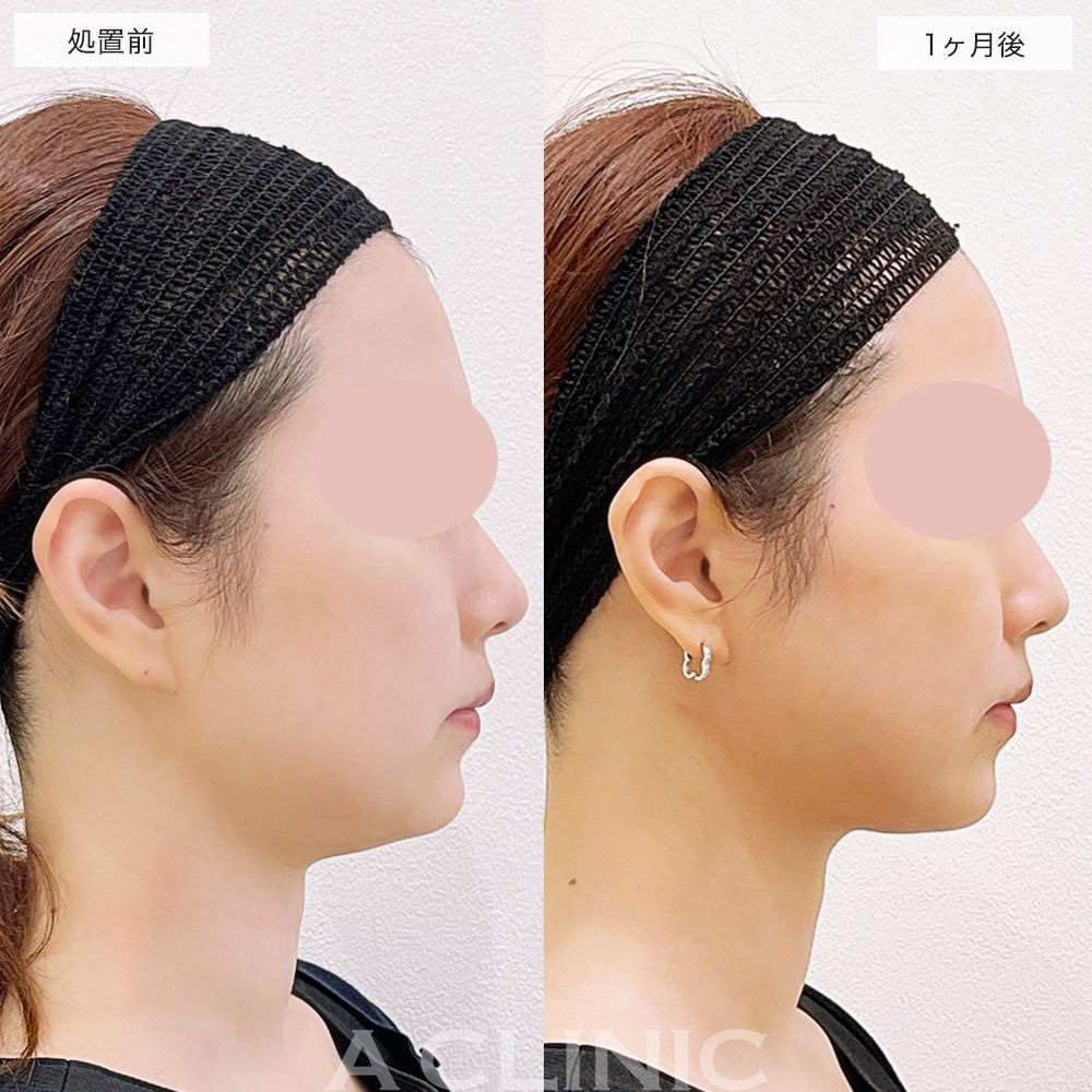 アゴ下とフェイスラインがスッキリして余白がかなり減りました！1day小顔脂肪吸引の処置前と1ヶ月後の症例です(20代女性)