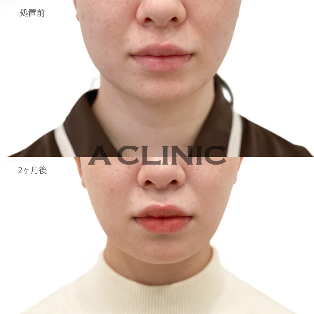 フェイスラインが引き締まりひと回り小さいお顔に変身！1day小顔脂肪吸引の処置前と2ヵ月後の症例です(20代女性)