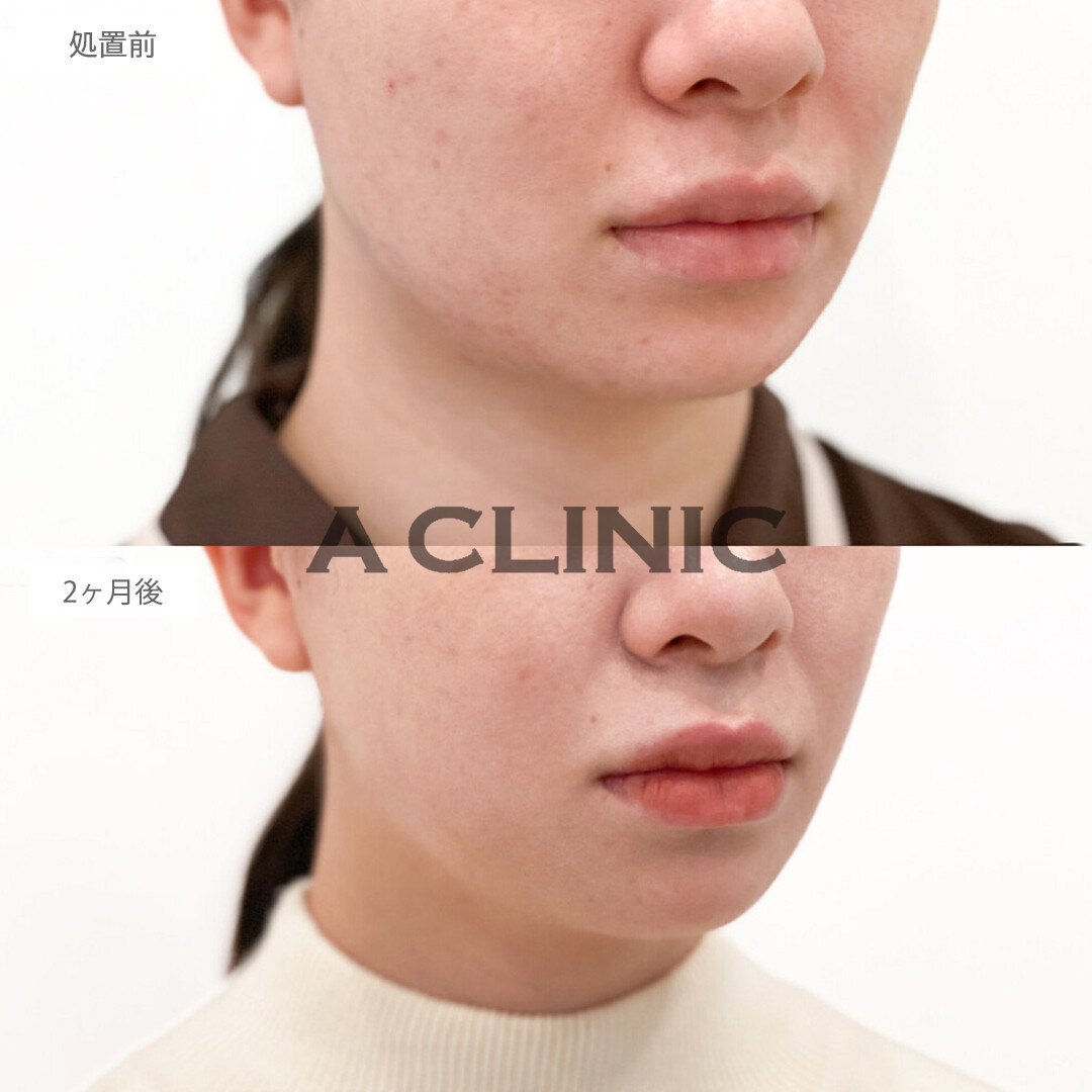 フェイスラインが引き締まりひと回り小さいお顔に変身！1day小顔脂肪吸引の処置前と2ヵ月後の症例です(20代女性)