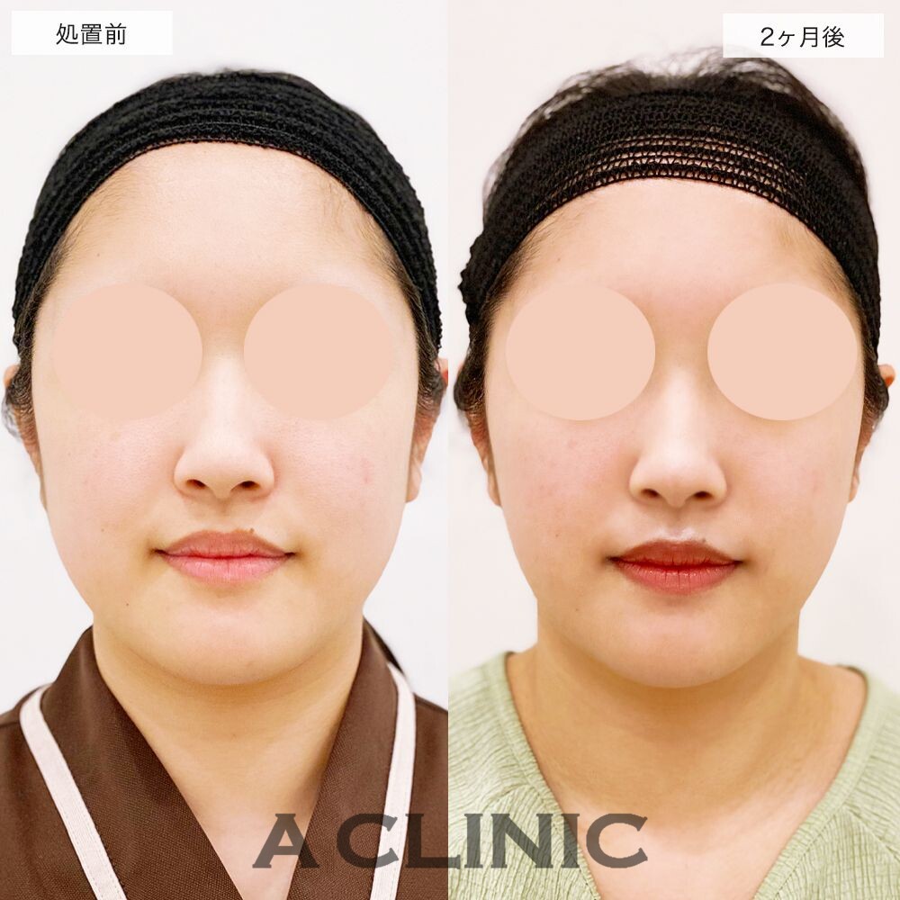 1day小顔脂肪吸引とバッカルファット除去術で膨らんだ頬のお肉がなくなりました♪処置前と2ヶ月後の症例です(20代女性)