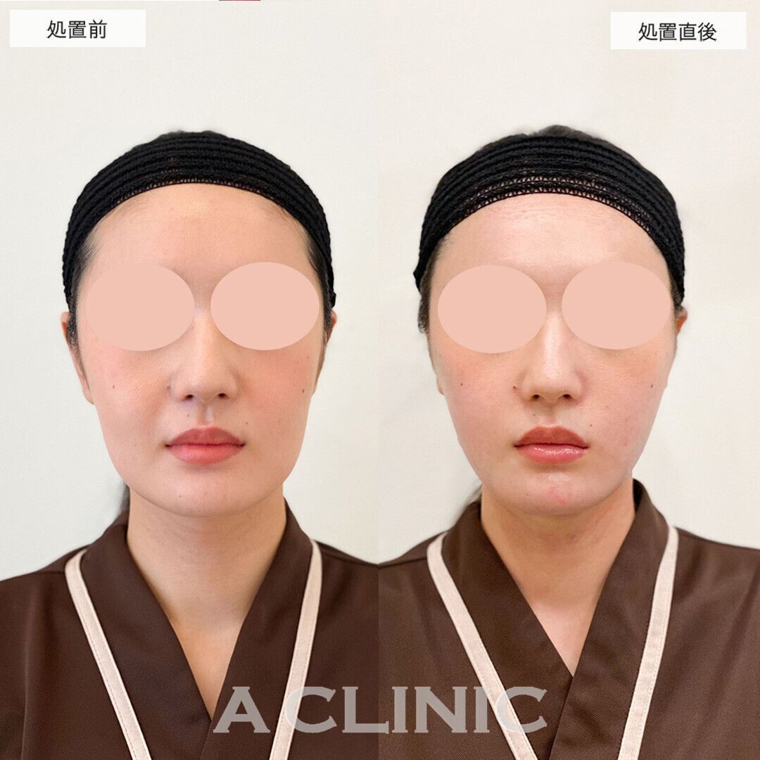 直後から綺麗なVフェイスに！1day小顔脂肪吸引の処置前と直後の症例です(20代女性)