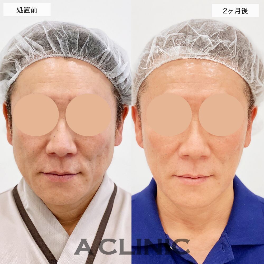 1day小顔脂肪吸引とバッカルファット除去は男性にも人気のある施術です！処置前と2ヶ月後の症例です(50代男性)