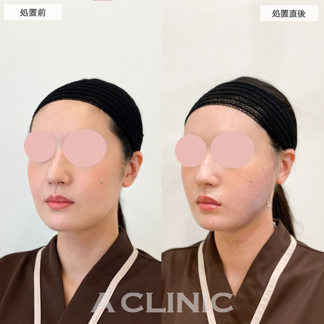直後から綺麗なVフェイスに！1day小顔脂肪吸引の処置前と直後の症例です(20代女性)