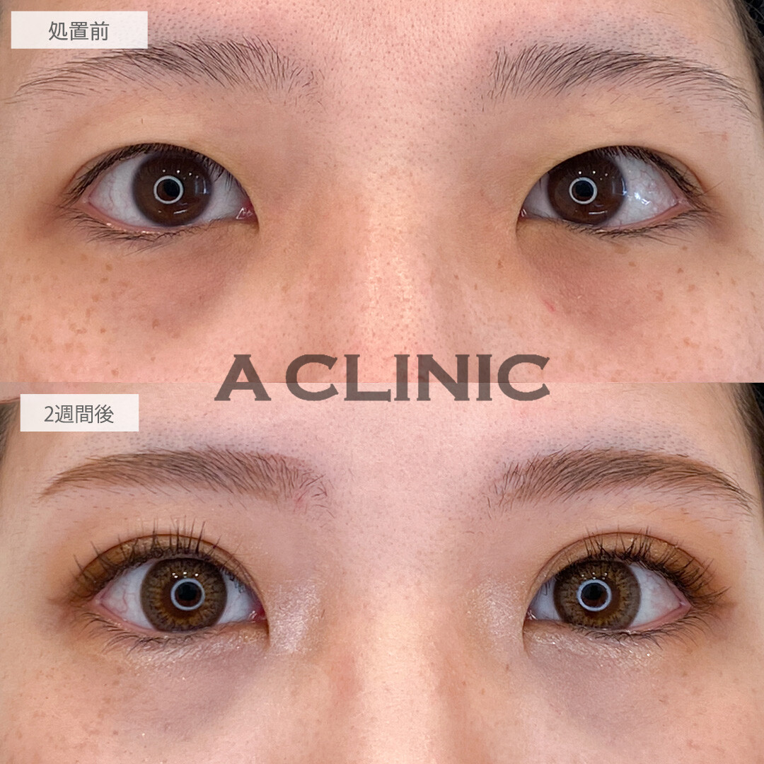 可愛い二重のぱっちりしたお目元に変身♪二重術埋没法の処置前と2週間後の症例です(30代女性)