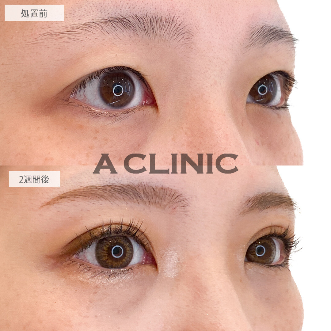 可愛い二重のぱっちりしたお目元に変身♪二重術埋没法の処置前と2週間後の症例です(30代女性)