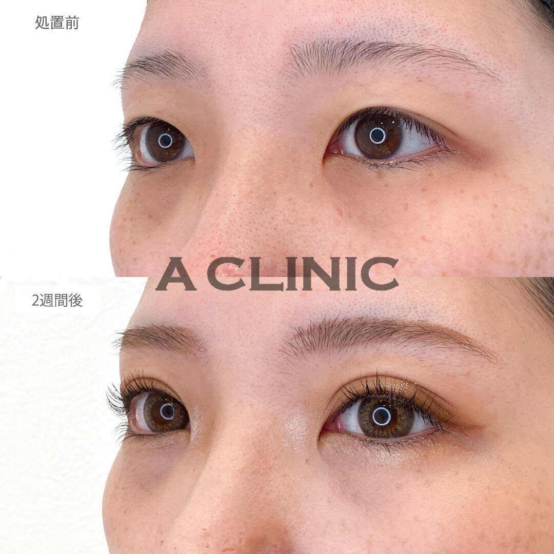可愛い二重のぱっちりしたお目元に変身♪二重術埋没法の処置前と2週間後の症例です(30代女性)