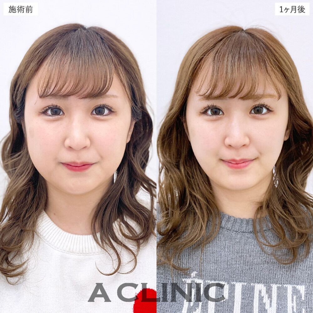 1day小顔脂肪吸引で簡単に美しいフェイスラインに。処置前、3日後、2週間後、1ヶ月後の症例です（20代女性）