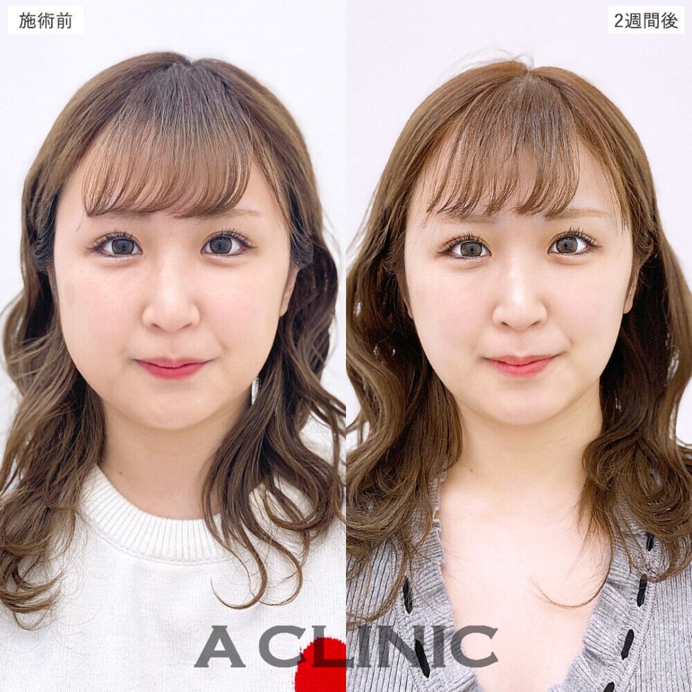 1day小顔脂肪吸引で簡単に美しいフェイスラインに。処置前、3日後、2週間後、1ヶ月後の症例です（20代女性）