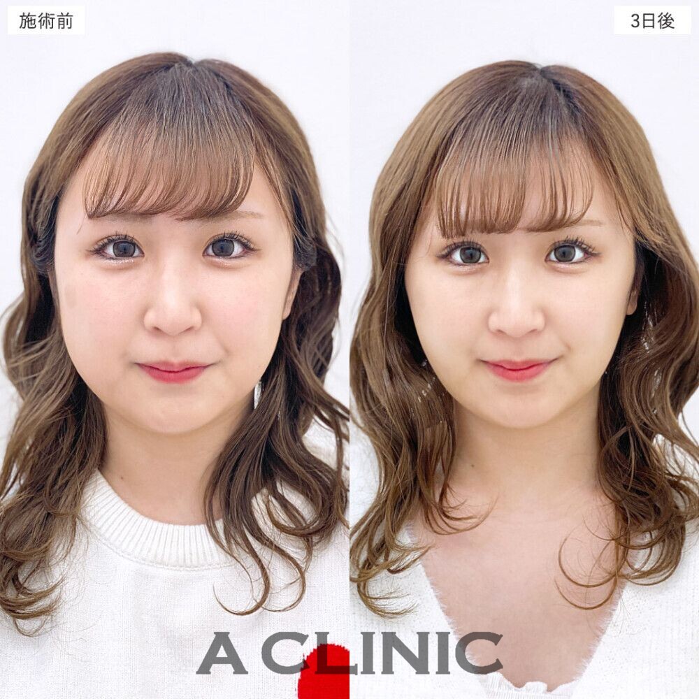 1day小顔脂肪吸引で簡単に美しいフェイスラインに。処置前、3日後、2週間後、1ヶ月後の症例です（20代女性）
