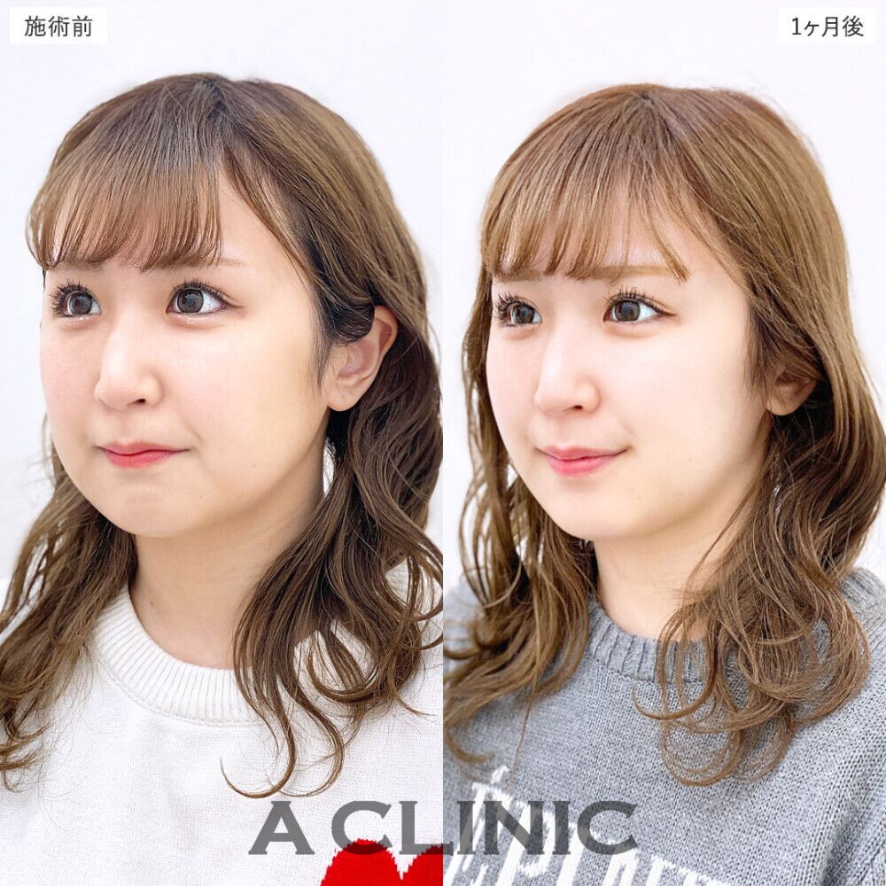 1day小顔脂肪吸引で簡単に美しいフェイスラインに。処置前、3日後、2週間後、1ヶ月後の症例です（20代女性）