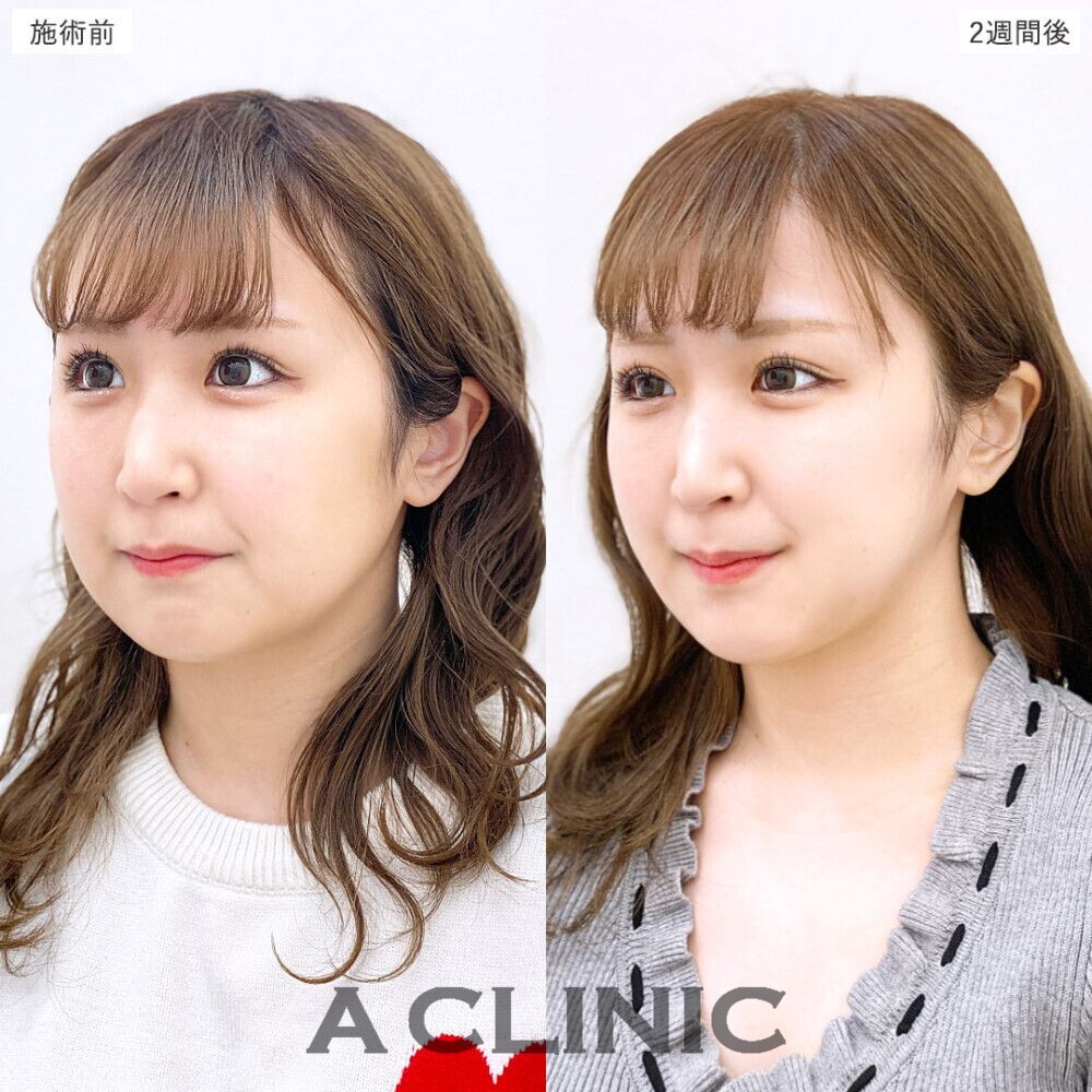 1day小顔脂肪吸引で簡単に美しいフェイスラインに。処置前、3日後、2週間後、1ヶ月後の症例です（20代女性）