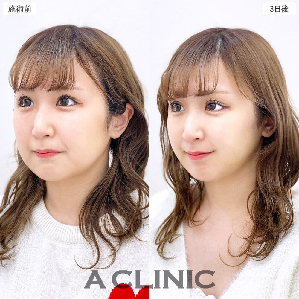 1day小顔脂肪吸引で簡単に美しいフェイスラインに。処置前、3日後、2週間後、1ヶ月後の症例です（20代女性）