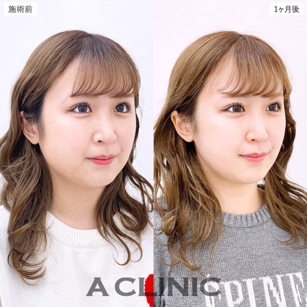 1day小顔脂肪吸引で簡単に美しいフェイスラインに。処置前、3日後、2週間後、1ヶ月後の症例です（20代女性）