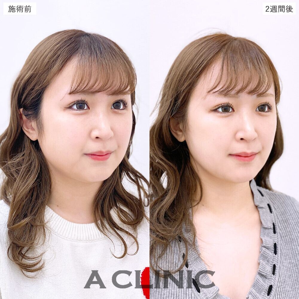 1day小顔脂肪吸引で簡単に美しいフェイスラインに。処置前、3日後、2週間後、1ヶ月後の症例です（20代女性）