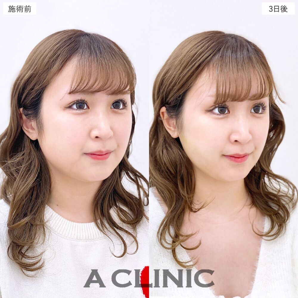 1day小顔脂肪吸引で簡単に美しいフェイスラインに。処置前、3日後、2週間後、1ヶ月後の症例です（20代女性）