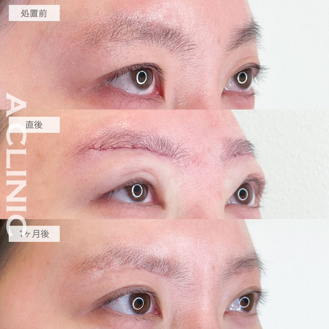 眉下リフトで瞼のたるみを除去して二重幅も広がりました！こちら処置前から1ヶ月後の症例です(20代女性)