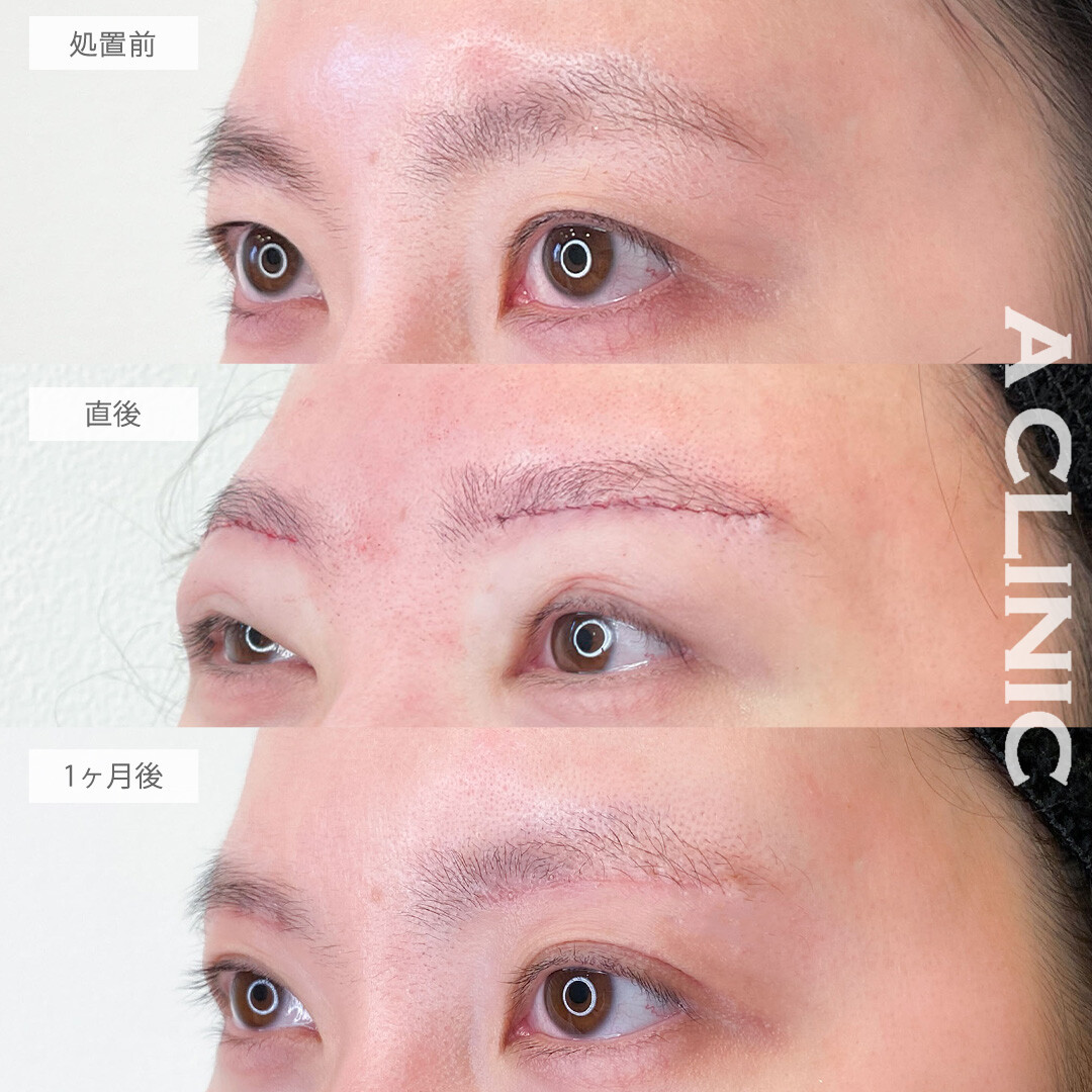 眉下リフトで瞼のたるみを除去して二重幅も広がりました！こちら処置前から1ヶ月後の症例です(20代女性)