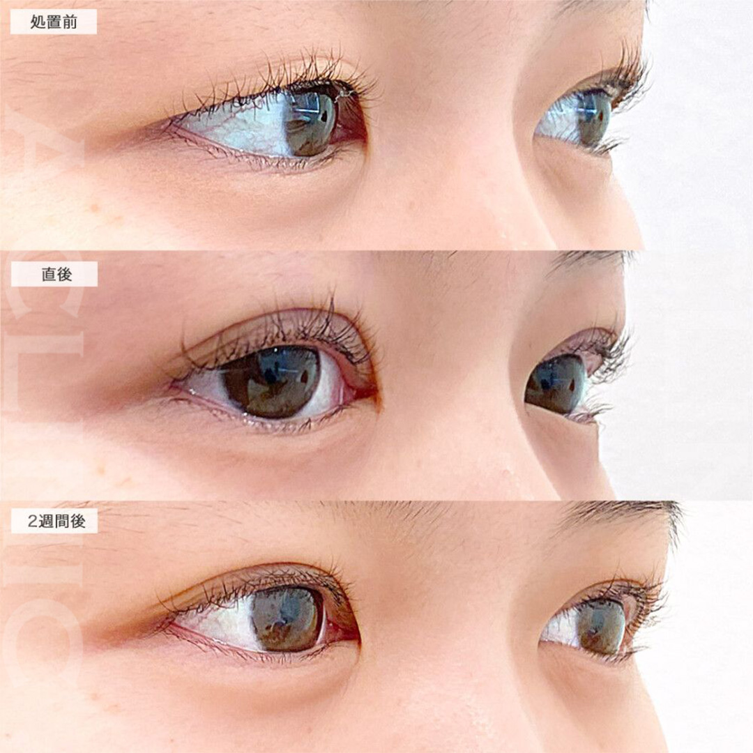 二重術埋没法で可愛らしいパッチリ目元に。処置前と直後と2週間後の症例です（10代女性）