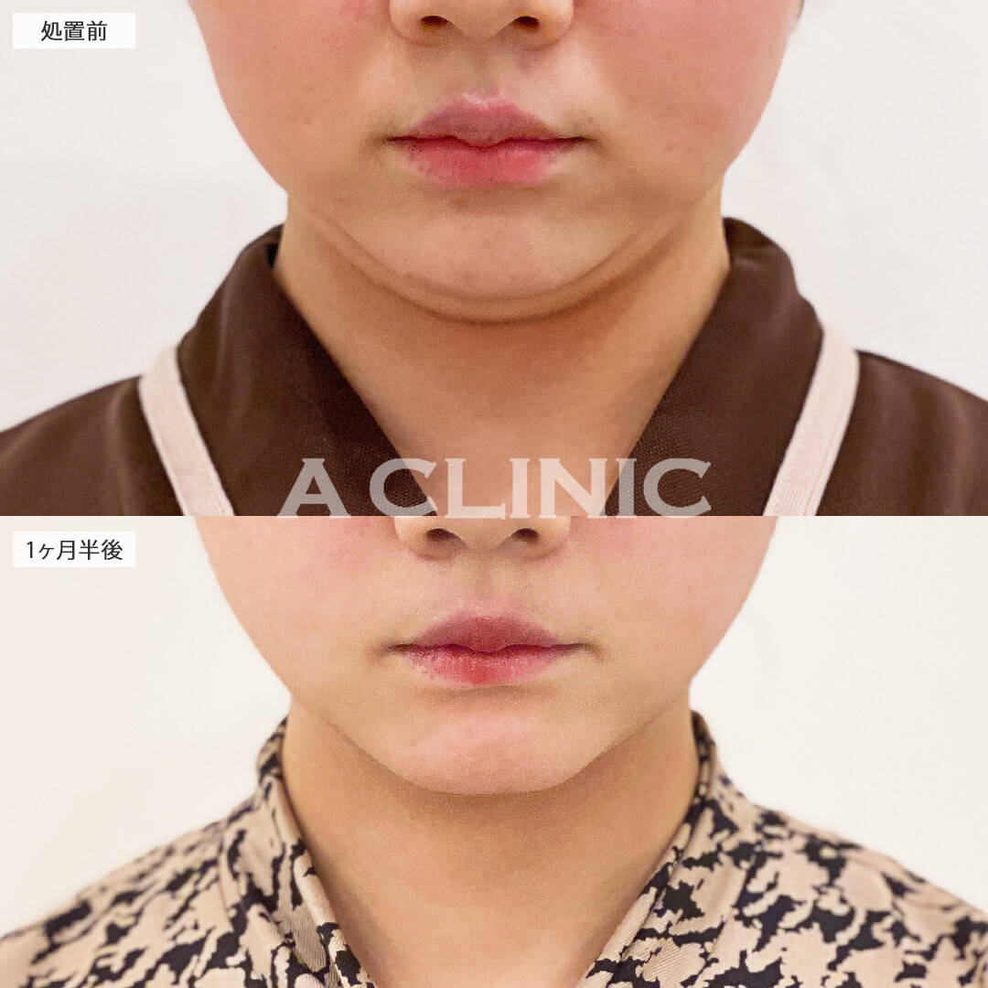 二重あごが消えてフェイスラインがスッキリしました！1day小顔脂肪吸引の処置前と1.5ヶ月後の症例です(20代女性)