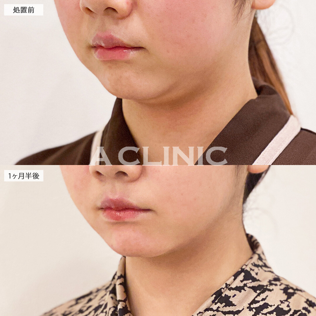 二重あごが消えてフェイスラインがスッキリしました！1day小顔脂肪吸引の処置前と1.5ヶ月後の症例です(20代女性)