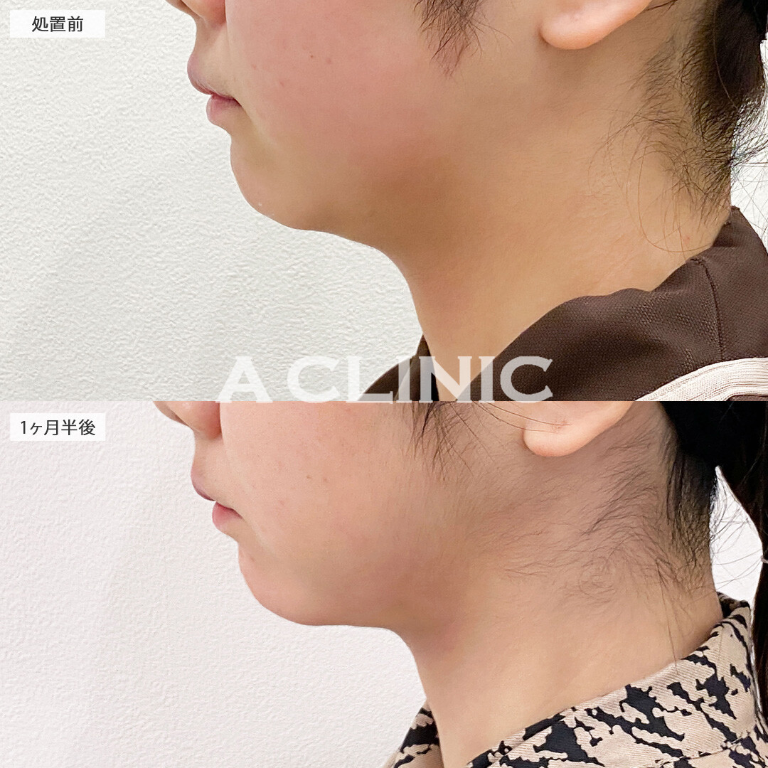 二重あごが消えてフェイスラインがスッキリしました！1day小顔脂肪吸引の処置前と1.5ヶ月後の症例です(20代女性)